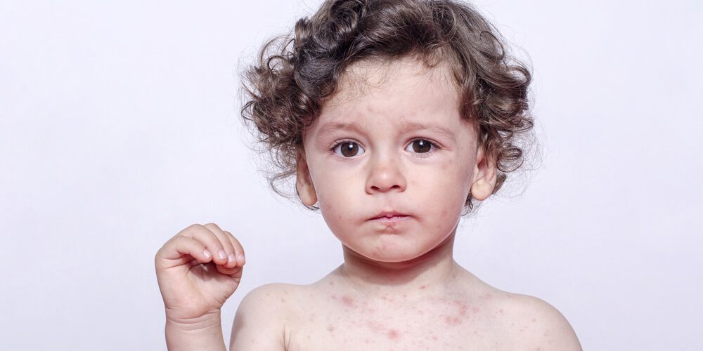 Kızamık enfeksiyonu